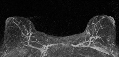 Minimal background parenchymal enhancement