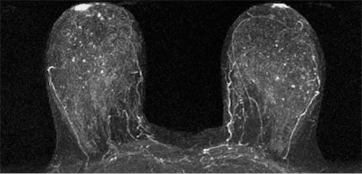 Moderate background parenchymal enhancement