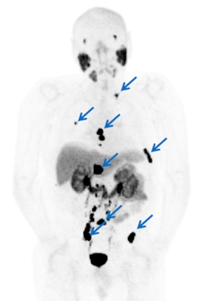 DCFPyL enhances the visual conspicuity of suspected sites (arrows) of metastatic prostate cancer. Image courtesy of Dr. Martin Pomper, PhD.