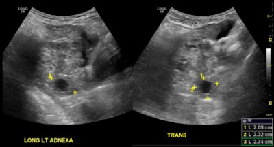 ER-performed ultrasound (top) was interpreted as not having an intrauterine pregnancy. On radiology ultrasound study (above), a radiologist diagnosed an ectopic pregnancy in the left adnexa. All images courtesy of Dr. Myrna Wallace-Severa.