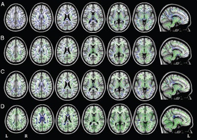 Axial and sagittal MR images show mean diffusivity results in patients with Alzheimer's matched with healthy controls. Increased mean diffusivity is seen in those with early-onset Alzheimer's (A), primary progressive aphasia (B), and posterior cortical atrophy (C) compared with the healthy controls (D). Image courtesy of Radiology.