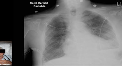 Patient photograph (lower left) facilitates correct identification of the chest radiograph. Image republished with permission of the American Roentgen Ray Society.