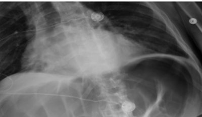 Bowel perforation from a wrong-patient error; above, image of patient on first day. Below, image of a different patient sent in error to the first patient's folder. Bottom, image of first patient developing bowel perforation as a result of error. All images courtesy of Dr. Gelareh Sadigh.