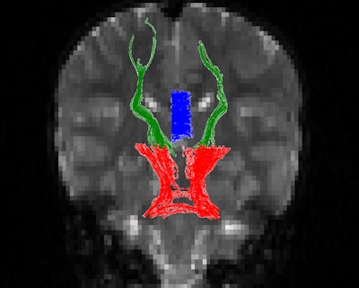 Images show white-matter tracts measured in the study. Cerebellothalamic tracts (red) connected the dentate nuclei to the inferior thalamus. Thalamocortical tracts (green) connected the thalamus to the dorsolateral prefrontal cortex. Corpus callosum tracts (blue) were selected from the sagittal images on either side of the midline. Images courtesy of Dr. Peter de Blank.