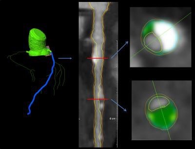 Images from a 62-year-old man. Left: coronary segmentation model of the coronary tree. Middle: curved multiplanar reconstruction of the left anterior descending artery, with the lumen and external vessel walls marked. Right: representative cross-sectional images, with green shading as noncalcified plaque. Images courtesy of RSNA.