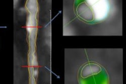 2015 06 02 15 34 00 238 Noncalcified Plaque 200