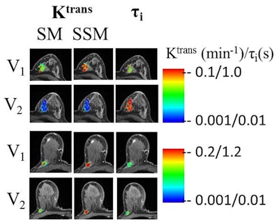 Two breast tumors before neoadjuvant chemotherapy (V1) and after one round of chemotherapy (V2). One subject was a pathologic complete responder (top two rows) and the other was a pathologic partial responder (bottom two rows). There was a substantial Ktrans decrease and τi increase after only one round of therapy in the complete responder compared to the noncomplete responder. Color bars indicate the coding of DCE-MRI biomarker values from small (blue) to large (red). Images courtesy of Alina Tudorica, PhD.