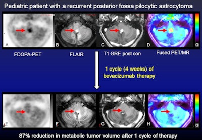 Dynamic FDOPA-PET and multiplanar pre- and postcontrast MR images were acquired simultaneously before and after bevacizumab. Representative axial images at baseline (A-D, top row) and after one cycle (four weeks) of bevacizumab (E-H, bottom row) are shown. There is focally increased FDOPA uptake in the tumor (A) with FLAIR hyperintensity (B) and dense postcontrast enhancement (C) (red arrows). The FDOPA-PET images demonstrate an 87% decrease in metabolic tumor volume after bevacizumab based on the amount of residual uptake 1.5-fold or greater than the mean SUV of the normal left frontal lobe reference region. In contrast, FLAIR MRI (G) shows no substantial change in tumor size, while postcontrast MRI (H) shows decreased contrast enhancement but no decrease in tumor size as expected with bevacizumab. Follow-up brain MRI for this patient over six to 12 months showed a decrease in tumor size from bevacizumab therapy. Images courtesy of Dr. Jonathan McConathy.