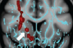2015 06 15 21 33 20 659 Alhilali Dti Brain Rad 200