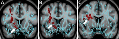 Diffusion-tensor images show how patients with depression have significantly decreased fractional anisotropy in the region of the right nucleus accumbens (A) (arrow) and the anterior limb of the internal capsule (B) (arrow) and superior longitudinal fasciculus (C) (arrow). The regions are involved in depressive disorders in nontraumatic and traumatic settings. Images courtesy of Radiology.
