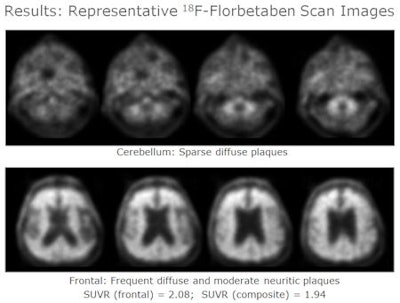 Gray matter in the cerebellum was used as the reference region (top row). PET images of the frontal cortex (bottom row) show florbetaben uptake in diffuse and neuritic beta-amyloid plaques. Images courtesy of Dr. Ana Catafau, PhD.