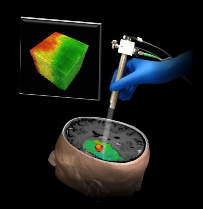 The new OCT technique could help surgeons distinguish tumor (red) from surrounding noncancerous tissue (green). Image courtesy of Dr. Carmen Kut, PhD; Dr. Jordina Rincon-Torroella; Xingde Li, PhD; Dr. Alfredo Quiñones-Hinojosa; and John Hopkins Medicine.