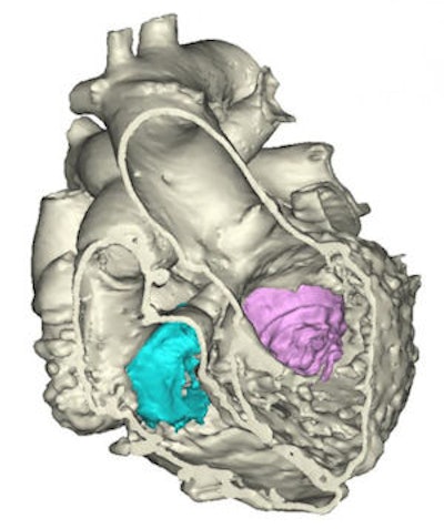 3D image of heart model. Image courtesy of Spectrum Health.