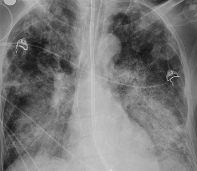 44-year-old man with end-stage renal disease who developed MERS. Frontal chest radiograph obtained at day 6 shows bilateral multifocal patchy airspace disease with predominant perihilar distribution and multiple areas of cavitation; chest radiographic score is 13. Image courtesy of AJR.