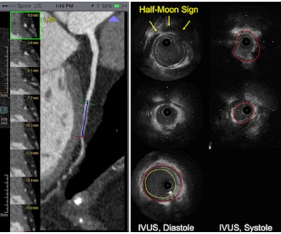Left, myocardial bridging with encasement of the coronary artery in the myocardium at CT. Right, echolucent half-moon sign in IVUS indicates myocardial bridging. Images courtesy of Dr. Hans-Christoph Becker.