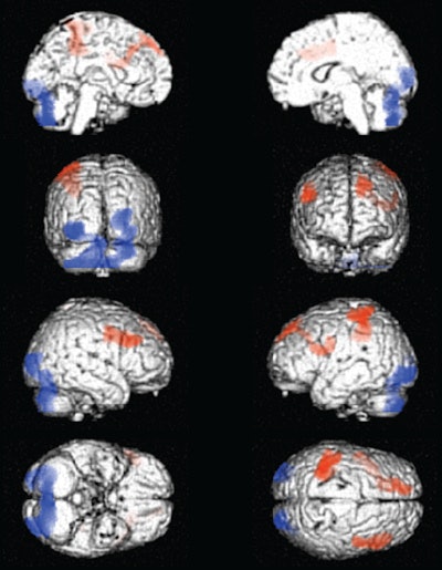 In the comparison of abstinent (left) and active (right) cocaine users, SPECT images showed areas of increased (red) and decreased (blue) perfusion. Image courtesy of Dr. Rodolfo Ferrando.