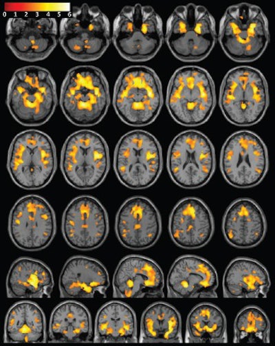 Consecutive T1-weighted MRI of the brain with superimposed population-level T-value map shows significantly greater grey-matter volume in female control subjects than in women with substance dependence, after correction for age, brain size, and years of education. Image courtesy of Radiology.