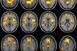 2015 07 13 16 34 48 263 Mri Grey Matter Radiology Tanabe 20150713233522