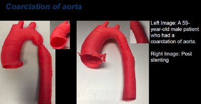 Coarctation of aorta. Right image is poststenting.