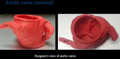 Normal aortic valve. All heart model images courtesy of Phillip Kim.