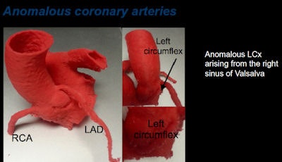 Anomalous coronary arteries, above and below.