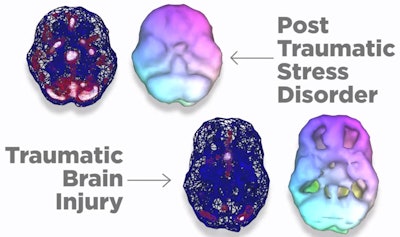 Top images illustrate increased perfusion in subjects with PTSD as reflected by the increased red and white throughout the brain (top left). Bottom images show decreased blood flow due to physical trauma in TBI as reflected by the decreased white and red, as well as holes in the volume-rendered image (bottom right). Image courtesy of Dr. Cyrus Raji, PhD.