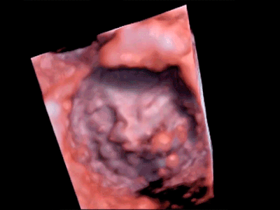 3D view of the mitral valve in motion. Image courtesy of GE Healthcare.