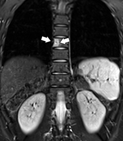 Whole-body MRI of an 18-year-old woman with rhabdoid tumor syndrome. Coronal (above) and axial (below) STIR images show focal hyperintense lesion (arrows) involving T8 vertebral body. The abnormality was considered moderate risk for malignancy and found to be a benign hemangioma on follow-up contrast-enhanced dedicated spine MRI. Images courtesy of AJR.