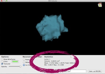 3D reconstructions of Mammi PEM breast images acquired in March (top) and April (bottom) during neoadjuvant chemotherapy show sharp reduction in tumor volume, from 0.8445 cm3 to 0.1705 cm3.