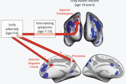 Findings from the study by Jensen et al published in JAMA Pediatrics this week. Gray matter volumes from 494 male participants were extracted using the FreeSurfer software in 30 regions of interest, shown here on an inflated brain (top: frontal view; bottom: medial views). Regions of interest found to associate with early adversity or internalizing symptoms are shown in red, while regions of interest that did not associate with adversity or internalizing symptoms are shown in blue. '-' indicates an association with lower volume, '+' indicates an association with greater volume. Image courtesy of Sarah K. G. Jensen.