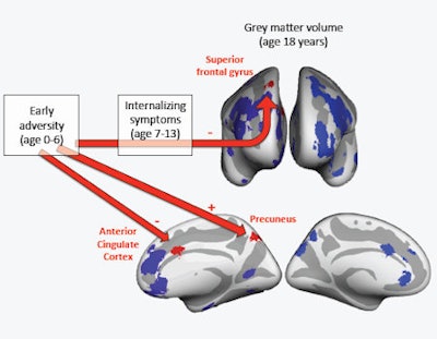 Findings from the study by Jensen et al published in JAMA Pediatrics this week. Gray matter volumes from 494 male participants were extracted using the FreeSurfer software in 30 regions of interest, shown here on an inflated brain (top: frontal view; bottom: medial views). Regions of interest found to associate with early adversity or internalizing symptoms are shown in red, while regions of interest that did not associate with adversity or internalizing symptoms are shown in blue. '-' indicates an association with lower volume, '+' indicates an association with greater volume. Image courtesy of Sarah K. G. Jensen.