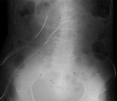Mobile x-ray image of an 80-year-old-woman with ileus, obtained on March 18, 2011, showing dark spots. All images courtesy of AJR.