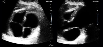 Figure 6: Apical four-chamber and mitral-valve views.