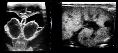 Figure 8: 27-week preemie with bilateral germinal matrix hematomas and polycystic kidneys.