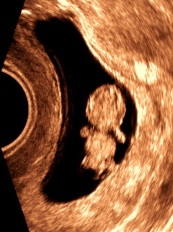 Figure 4: 7.8-week embryo.
