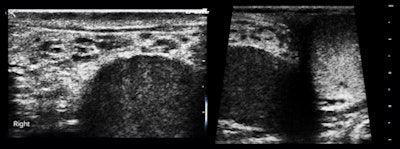 Figure 2: The right testis is embedded within a thick attenuating rind.