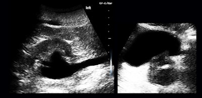 Figure 7: Hydronephrosis, hydroureter, and an abnormal prostate.