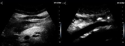 Figure 3: An obese woman with a fatty pancreas and a pristine aortic wall.