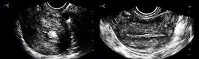 Figure 5a and b: A long-axis view of a retroverted uterus with stalked polyps and perhaps a touch of adenomyosis, and a transverse image of a normal fundal endometrium.