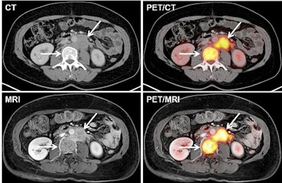 Images of a patient with a recurrence of cervical cancer. CT and MRI show a para-aortic lymph node metastasis and bone metastasis (arrows), which disclose pathological glucose metabolism on fused PET/CT and PET/MR images. Courtesy of Dr. Johannes Grueneisen.