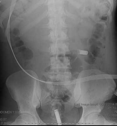 A patient who swallowed two AAA batteries. Images above and below show batteries progressing through the colon.