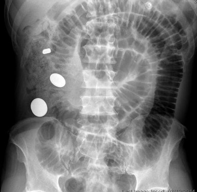 A patient with history of traumatic brain injury presented with abdominal pain and vomiting; was found to have small bowel obstruction on radiograph and incidentally also had multiple round, opaque foreign bodies. A retained bullet from a prior gunshot was also noted. All images courtesy of Dr. Hsiang-Jer Tseng.
