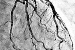 2015 09 04 14 00 18 46 Coronary Stenosis 450 20150904210057