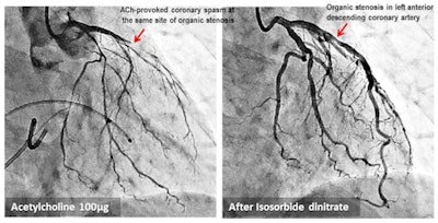 Cardiac cath image shows spasm at site of organic coronary stenosis. Credit: Prof. Mitsuyoshi Nakao. Shared via Creative Commons license.