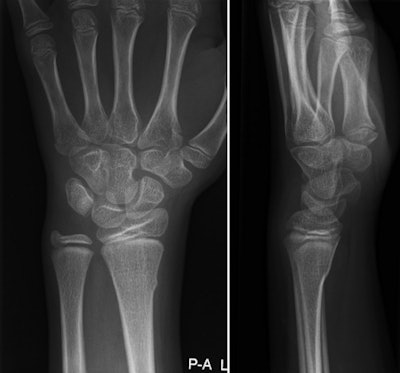 Buckle fracture of the distal radius in a 9-year-old girl. Left, posteroanterior view; right, lateral view. Images courtesy of Dr. Annelie Slaar.