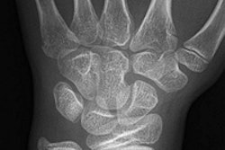 2015 09 14 14 38 04 630 Slaar Wrist Fracture 200