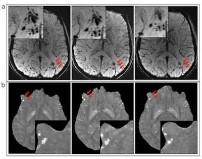 (A) Susceptibility-weighted MRI and (B) quantitative susceptibility mapping show the evolution of microbleeds (arrows) in a patient who had follow-up imaging. Image courtesy of RSNA.