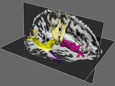 DTI-MRI illustrates the main tracts affected by hypertension. Reconstruction shows lower fractional anisotropy levels in regions including the anterior thalamic radiations, superior longitudinal fasciculus, and cingulate gyrus, resulting in significant deterioration in hypertensive patients. Image courtesy of Daniela Carnevale, PhD.