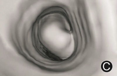 Adenoma in trachea