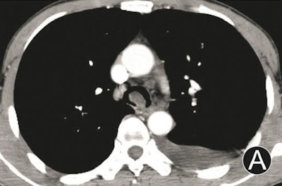 Adenoma in trachea carina. MDCT axial (A), MPR (oblique, B), and virtual bronchoscopy (C) images. The images revealed a mass that protruded into the endolumen with a narrow peduncle connected to wall, no thickened wall, severe eccentric luminal stenosis, and homogeneous density without obvious enhancement. Images republished with permission of PLOS One, September 2, 2015.
